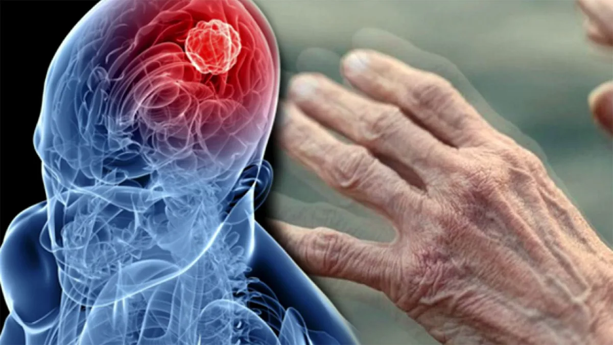 Parkinson’da Devrim Niteliğinde Gelişme